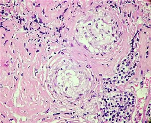 ntses tuberculosis granulomas